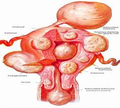 Fibroid rahim memiliki ukuran yang bervariasi, mulai dari sekecil benih sehingga tidak bisa terdeteksi oleh mata, sampai yang berukuran besar yang dapat menekan dan memperbesar rahim. Perut Buncit Senggugut Teruk Kerap Terkencing Susah Mengandung Simptom Wanita Mungkin Ada Fibroid Mingguan Wanita