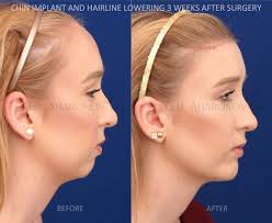 Hariline Lowering Chin Implant Forehead Reduction Surgery 01 Jpg 1200 984 Forehead Reduction Forehead Reduction Surgery Reduction Surgery