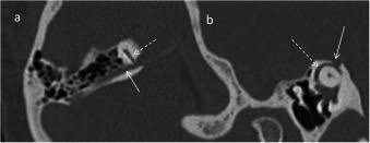 Image result for Myringosclerosis