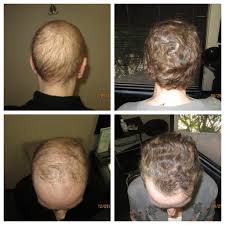 Hair loss occurs after undergoing chemotherapy sessions after sometime depending on the type and the dosage of the chemotherapy drug that one receives. Tm Hair Chemotherapy Hair Loss And Solutions