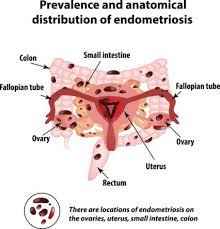 Endometriosis Distribution Endometriosis Endometriosis Symptoms Ovarian Cyst Symptoms