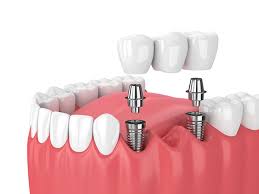 Dental Implants in New Westminster, BC | Dental Implants near you