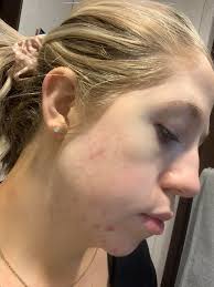 I had terrible acne and I was so self-conscious about it that I wouldn't  even look at myself in the mirror. I hated my skin and felt like everyone  was staring at