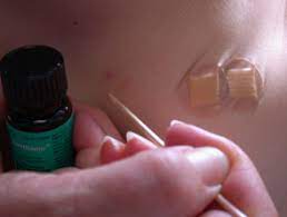 Will liposuction get rid of the roll of skin i have in my. Cantharidin Dermnet Nz