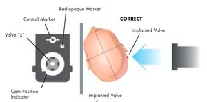 Shunt codman hakim settings valves programmable vp csf certas radiology adjustment valve xray pressure mri shunts. Epos
