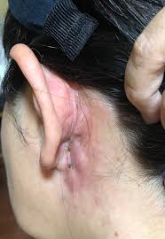 術後30日目 耳は確かにあるけれど、私の？ | 耳下腺腫瘍ブログ