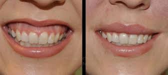 There are different methods of correcting a gummy smile. Gummy Smile Don T Bother We Can Fix It