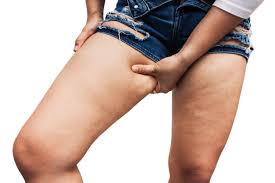 Como Eliminar La Celulitis De Las Piernas Y Gluteos Rapidamente Cremas Caseras Para Eliminar La Flacidez En Los Muslos Quitar Celulitis Piernas Eliminar Celulitis Piernas Celulitis Piernas
