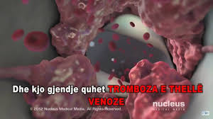 Postoje dva oblika tromboze, venska i arterijska tromboza. Tromboza Dhe Embolia Pulmonare Youtube