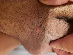 Ingrown hair bump under skin. Is This Gw Hpv Pimple Ingrown Hair Its Painful Like A Ingrown Hair Type Of Pressure Kinda Hard From The Pressure Build Up Like A Pimple Or Ingrown Hair Genitalwarts