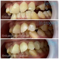 Gigi gigi tiruan modern juga bisa dibuat menyerupai gigi alami dan tersedia dalam berbagai macam. Harga 1 Gigi Palsu Tanam Info Lif Co Id