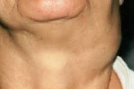 The characteristics of these lumps include: Head And Neck Cancers What To Look Out For Life Culture The Business Times