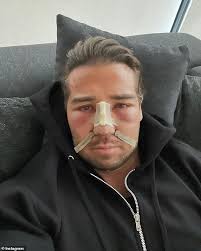 TOWIE star James Lock shares post-surgery photos of his 'new face' after he  fractured his eye sockets and nose in brutal accident