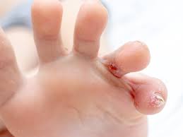 Image result for pompholyx soles of feet