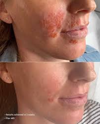 We are so excited to share Laura's results from the Dermalogica Melanopro  Peel! ✨ You might remember the video we shared of Laura before Christmas,  now here we are showing the incredible