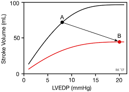 Image result for Systolic Dysfunction