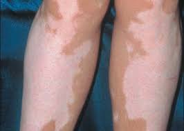 Plecând în vacanță la mare, dorim să ne întoarcem de acolo cu un bronz neted și auriu. Ciuperci Albe Pe Piele Vitiligo Danihilldesign Com