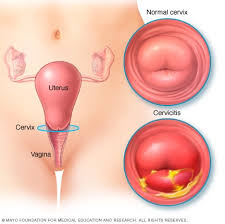Image result for Friable Cervix