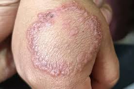 Image result for Hand Infection