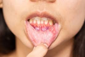 Image result for mouth ulcer on tongue)