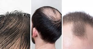 Ada juga yang mengaitkan keguguran rambut. Semakin Dekat Majlis Semakin Banyak Rambut Pengantin Lelaki Gugur Pesona Pengantin