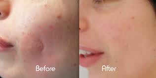 It all depends on what kind of scar it is, how old the scar is (recent surgery) and whether the scar has had usually for any recent surgery, massaging the scar often yields the best results in keeping the. Best Natural Remedies To Get Rid Of Acne Scars Best Health And Beauty