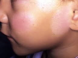 Pityriasis alba pityriasis lichenoides pityriasis rosea pityriasis rubra pilaris pityrosporum folliculitis Definiciones Dermatologia Archives Seite 140 Von 233 Dermatly Com El Sitio De Tu Piel