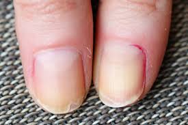 Et on évite d'avoir l'ongle nu : Ongle Qui Se Dedouble Causes Et Traitements Manucure Beaute