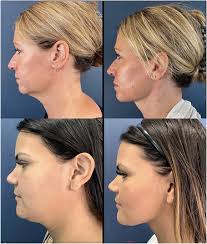 Northeastern Society of Plastic Surgeons Craniomaxillofacial Abstracts  Presented at the 41st Annual Meeting, 2024