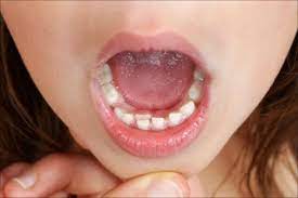 Baby Teeth Faq Dentistry For The Entire Family Fridley Mn