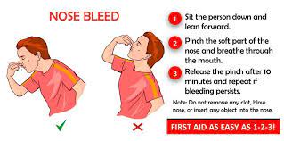 How To Treat And Prevent Nosebleeds - Shoensafety Llc