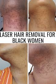 It leaves the skin looking smoother and silkier than waxing, electrolysis or razors and is a gentle technique that can treat larger areas effectively with minimal discomfort and. Laser Hair Removal Laser Hair Removal Face Hair Removal Laser Hair Removal