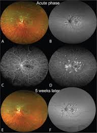 Gass initially suggested that inflammation of the retinal pigment epithelium. Choroidal Involvement In Acute Posterior Multifocal Placoid Pigment Epitheliopathy Ophthalmic Surgery Lasers And Imaging Retina