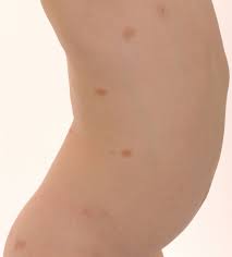 Image result for Urticaria pigmentosa children