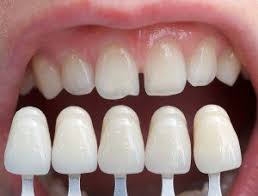 How Long Do Porcelain Veneers Last Wilkinson Dental