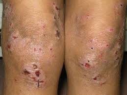 Image result for Atopic Dermatitis