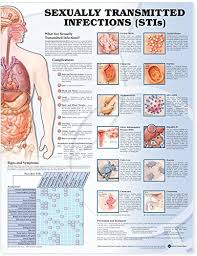 Sexually Transmitted Infections Stis Chart Unmounted