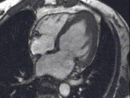 For example, genetic mutations with a predominantly. Cardiac Magnetic Resonance Imaging Group Cardiovascular Medicine Medical College Of Wisconsin