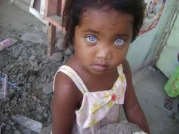 Black And Blue Eyes After Head Injury Mangyan People With Blue Eyes Beautiful Eyes Color Beautiful Eyes