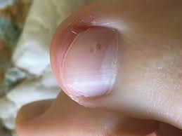light brown spot underneath toe nail