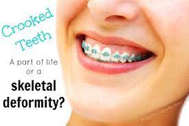 Crooked Teeth A Part Of Life Or Skeletal Deformity Teeth Straightening Teeth Braces Teeth After Braces