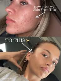 Transforming my skincare journey with Susenji Luna