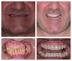 See full list on thedentalguide.net Dental Veneers Surrey Chipped Broken Teeth Treatment