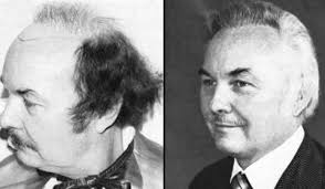 HISTORY OF THE HAIR TRANSPLANT