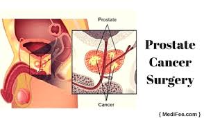 Prostate cancer is one of the most common types of cancer diagnosed in men. Prostate Cancer Surgery Treatment Procedure Risks And Recovery