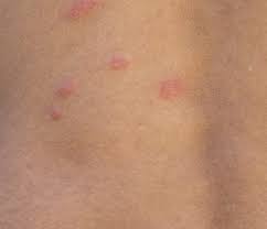 Image result for flea bites