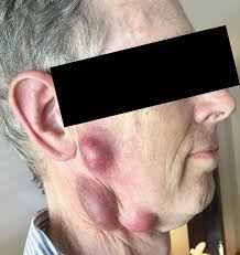 It moves with the skin and feels quite hard. Man Catches Life Threatening Disease From His Cat Leaving Him With Horrific Lumps On His Neck