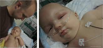 Our Journey of Ethan's Head Surgery... Craniosynostosis: Wednesday