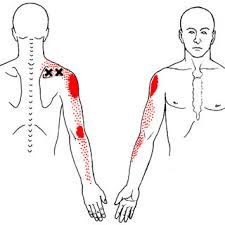 Inflammation develops in the shoulder that causes pain and stiffness. Referred Pain Pattern Red From Supraspinatus Muscle Mtrp Download Scientific Diagram