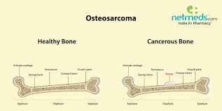 Cancerous cells can weaken the bone, and this may sometimes result in a fracture. Osteosarcoma Causes Symptoms And Treatment